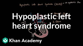 Hypoplastic left heart syndrome and norwood glenn fontan  NCLEXRN  Khan Academy [upl. by Dee Dee]