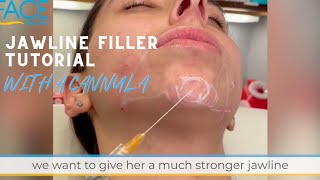 Jawline Filler and Chin Filler Cannula Tutorial [upl. by Baily]