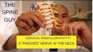 CERVICAL STENOSIS RADICULOPATHY PART 1  SYMPTOMS IMAGING AND PATIENT EXAM [upl. by Beore]