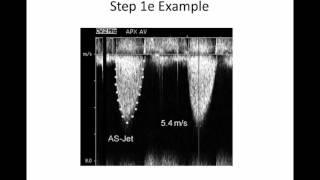 Intro to Aortic Stenosis [upl. by Natanhoj]