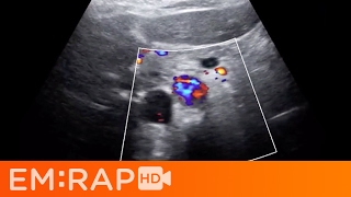 Ultrasound of Aortic Dissection [upl. by Beeck]