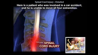 Spinal Cord Injury Detailed  Everything You Need To Know  Dr Nabil Ebraheim [upl. by Subak609]