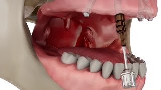 Straumann Pro Arch Step by Step Overview [upl. by Schlenger58]