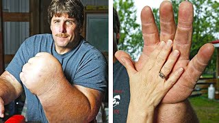 Gigantism Causes Signs and Symptoms Diagnosis and Treatment [upl. by Chae]