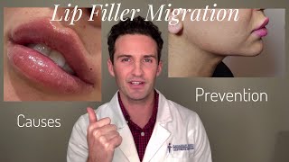 Lip Filler Migration Causes amp Prevention [upl. by Brunn]