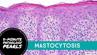 Mastocytosis Urticaria Pigmentosa 5Minute Pathology Pearls [upl. by Nadoj]