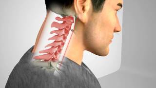 Denneroll Cervical Orthotic Animation [upl. by Otte272]